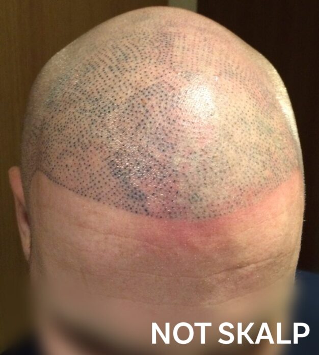 Bad Scalp Micropigmentation