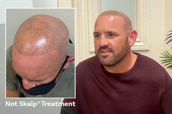 Bad Scalp Micropigmentation