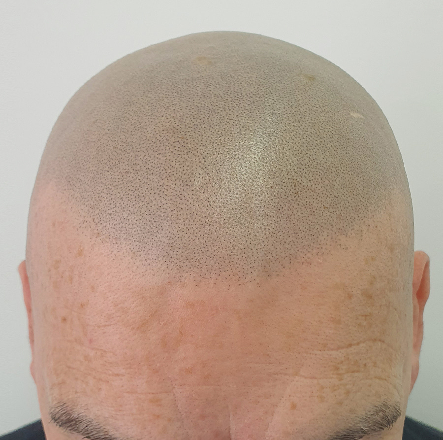 Best Scalp Micropigmentation result