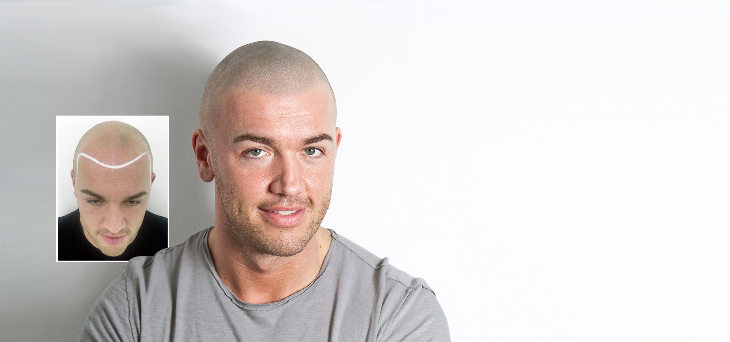 Best Scalp Micropigmentation hair tattoo clinic