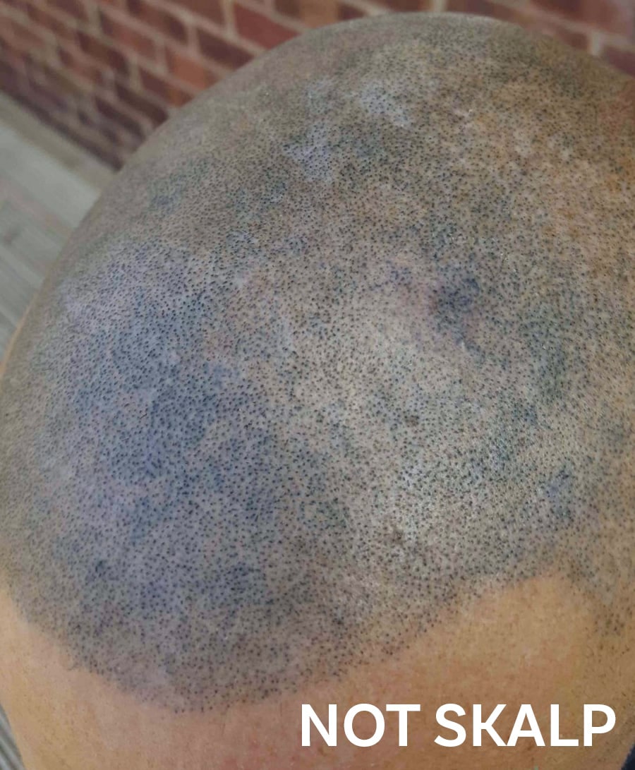 Botched Scalp Micropigmentation
