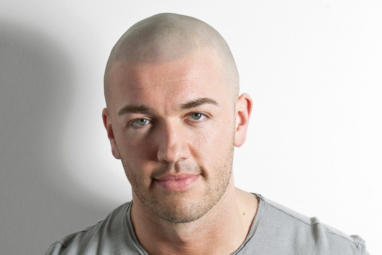 Dublin Scalp Micropigmentation