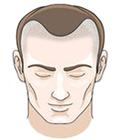 Receding Hairline SMP Cost
