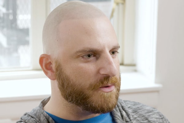 Scalp Micropigmentation Los Angeles Adam