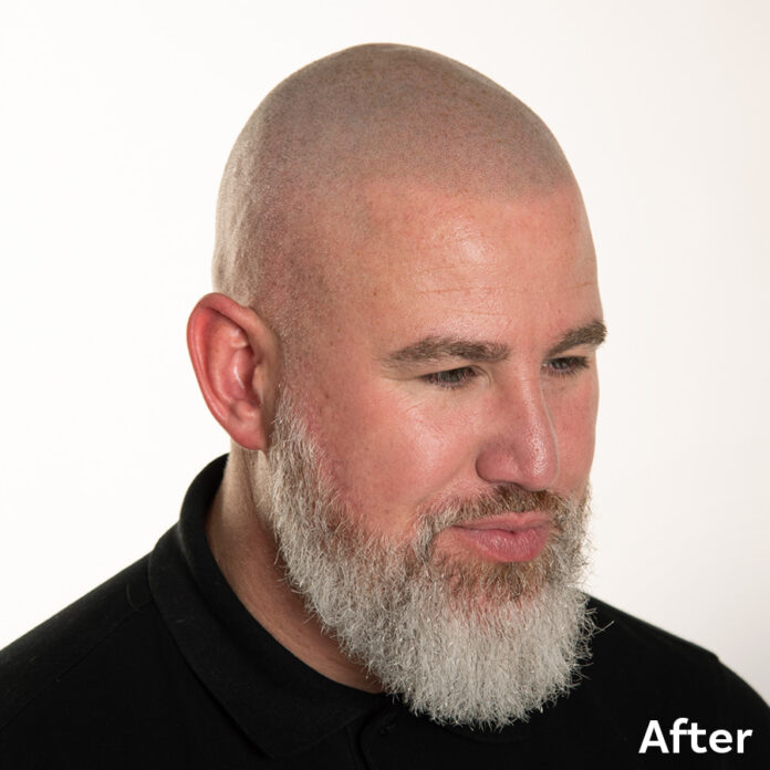 Scalp Micropigmentation Adrian After