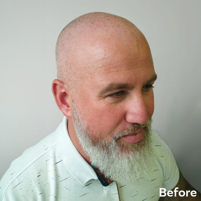 Scalp Micropigmentation Adrian Before