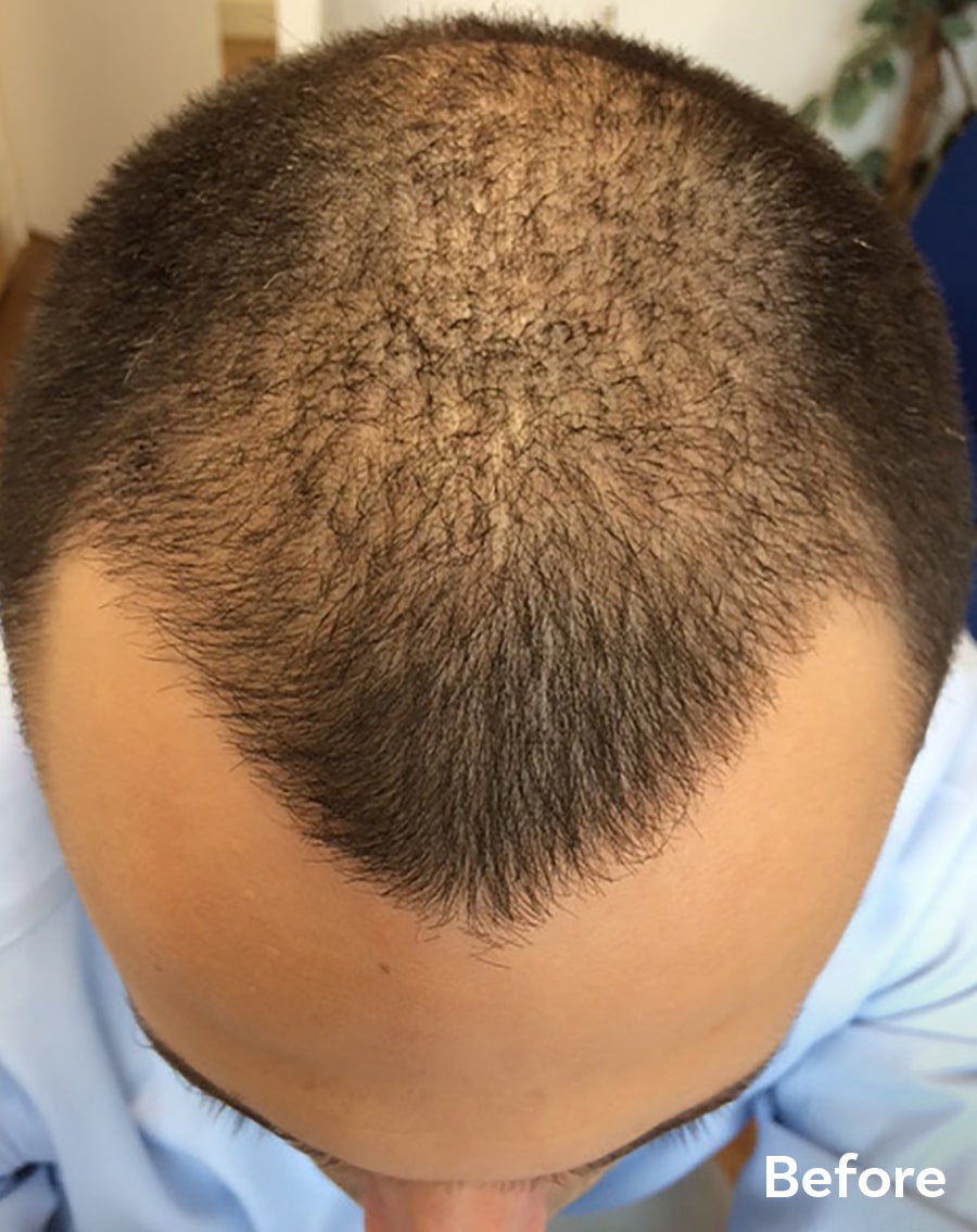 Scalp Micropigmentation after Hair Transplant