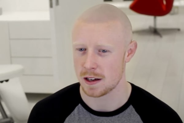 Scalp Micropigmentation Manchester Anthony