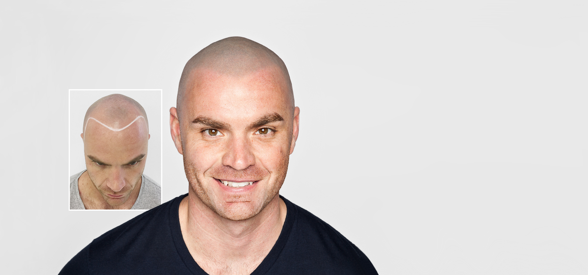Best Scalp Micropigmentation clinic