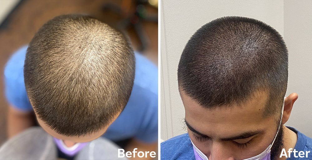 Scalp Micropigmentation Density treatment