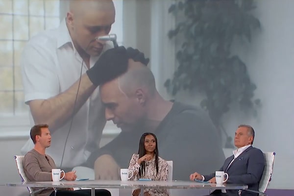 Scalp Micropigmentation Los Angeles Drs Tv