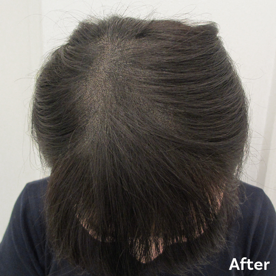 Scalp Micropigmentation for Women