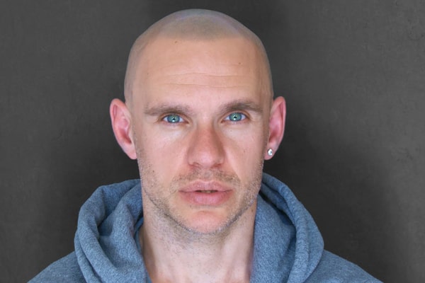 Scalp Micropigmentation London Gerbeshi