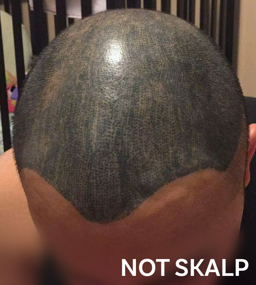 Scalp Micropigmentation Gone Wrong