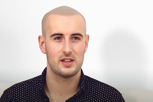 Scalp Micropigmentation London Jack