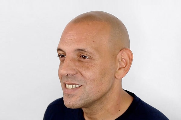 Scalp Micropigmentation London Jesus