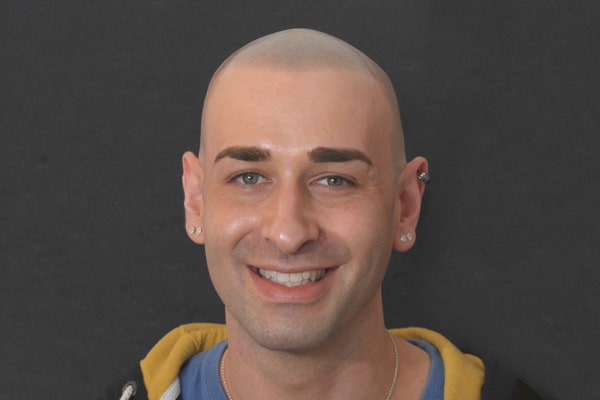 Scalp Micropigmentation London Joe 1