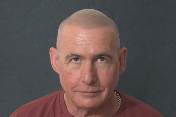 Scalp Micropigmentation London Les