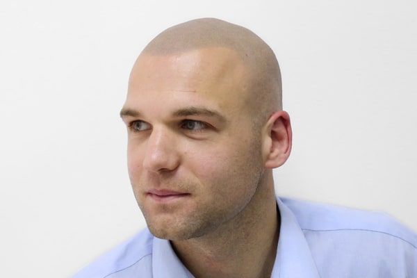 Scalp Micropigmentation Manchester Liam