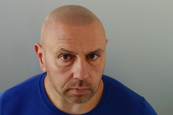 Scalp Micropigmentation Manchester Mark