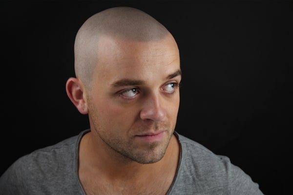 Scalp Micropigmentation London Ollie