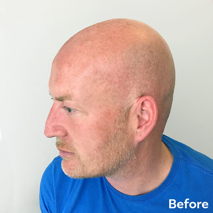 Scalp Micropigmentation Paul Before