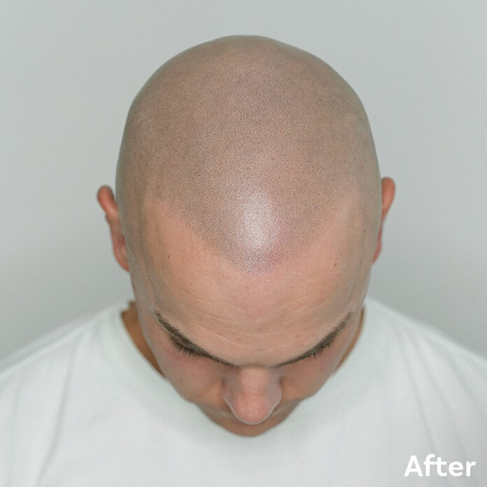 Scalp Micropigmentation Richard After