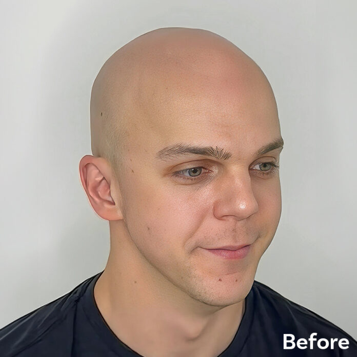 Scalp Micropigmentation Richard Franks Before