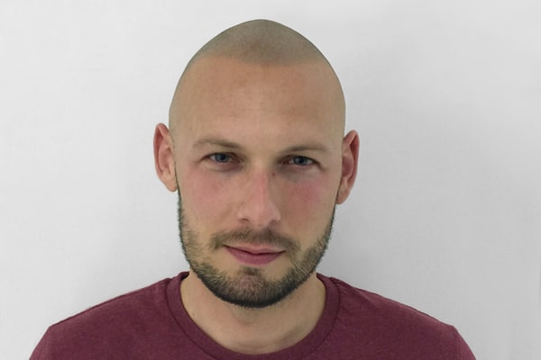 Scalp Micropigmentation Manchester Robert