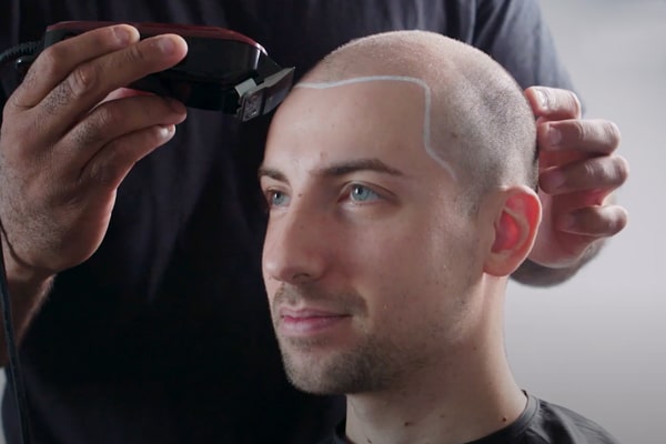 Scalp Micropigmentation Sam