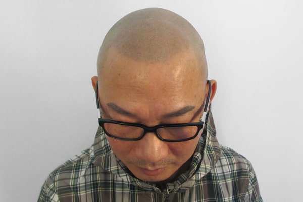 Scalp Micropigmentation London Thim