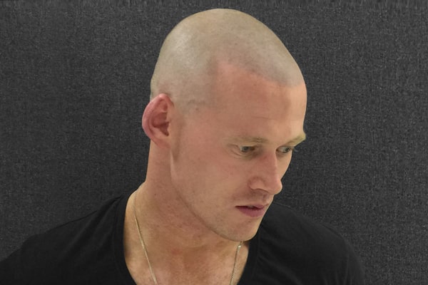 Scalp Micropigmentation Manchester Tom