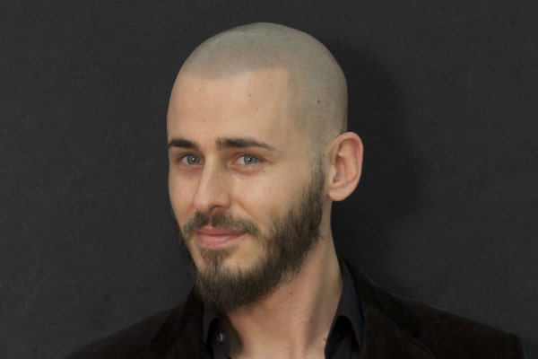 Scalp Micropigmentation London Tony A