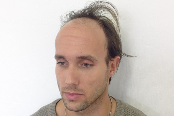Scalp Micropigmentation Tony C