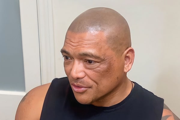 Scalp Micropigmentation video Rony
