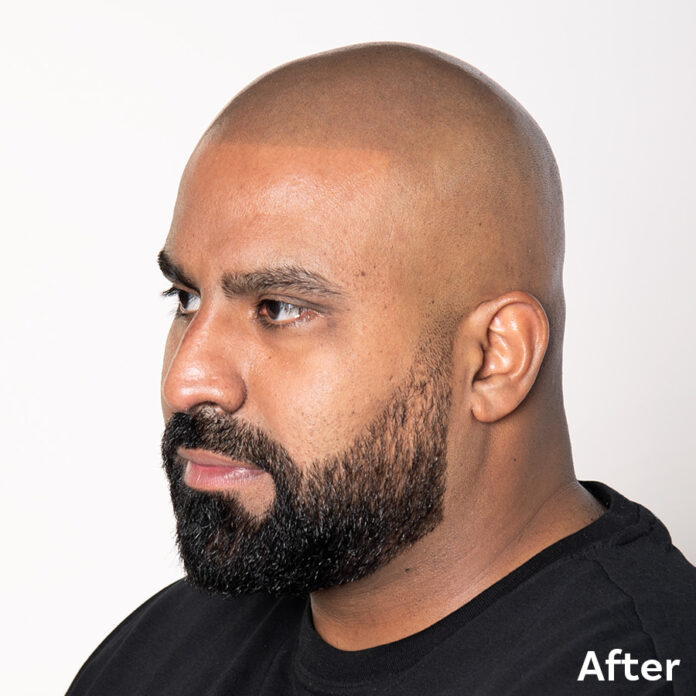 Scalp Micropigmentation Waqar after
