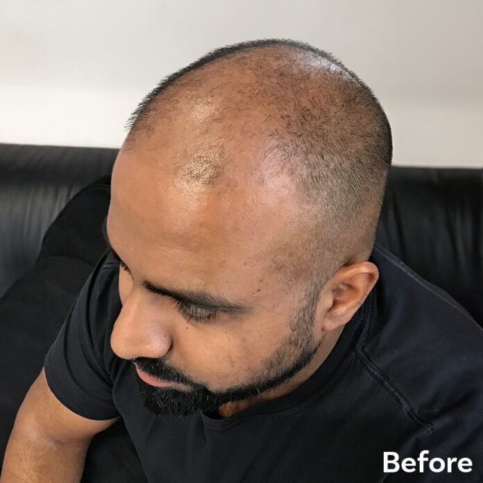 Scalp Micropigmentation Waqar before