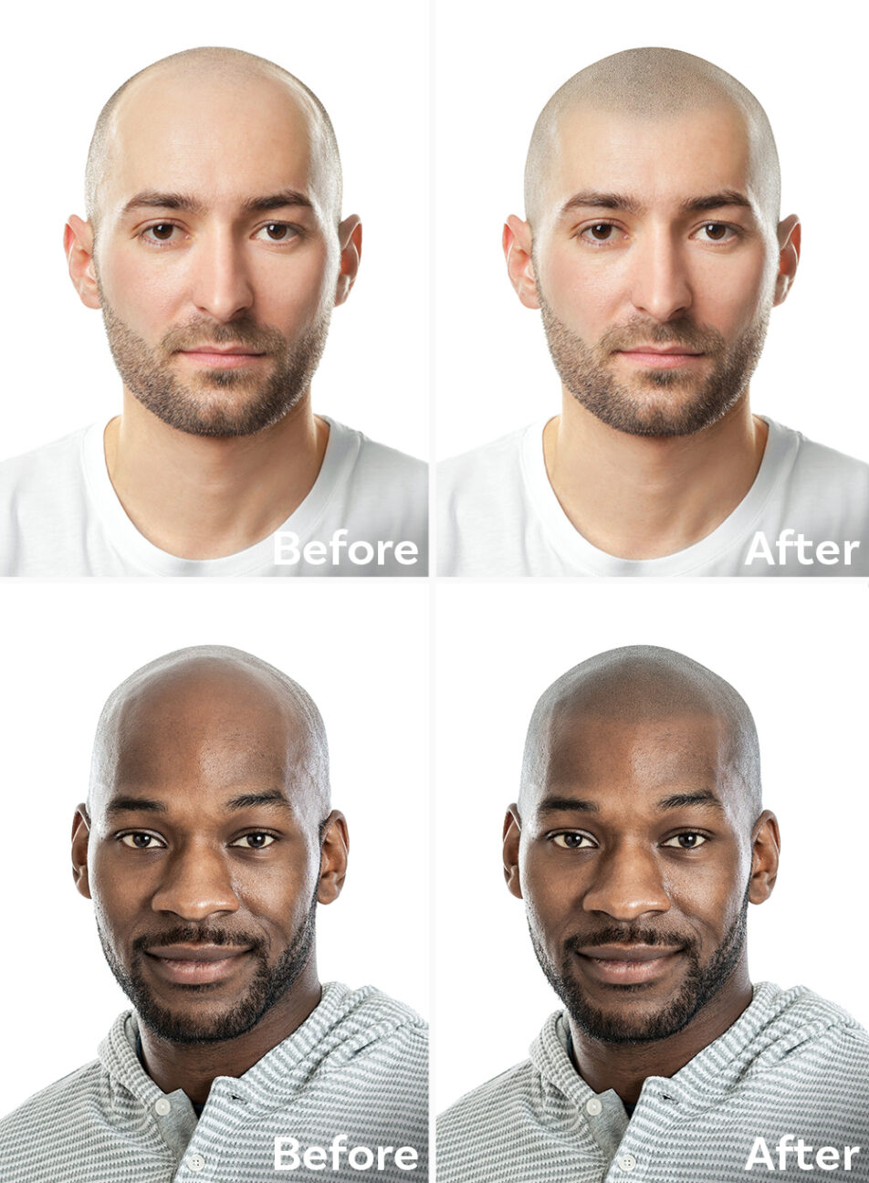 Scalp Micropigmentation Virtual Hairline Mockup