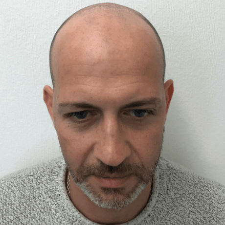 how does scalp micropigmentation work with grey hair