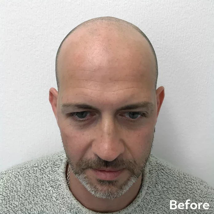 Best Scalp Micropigmentation Antonio before