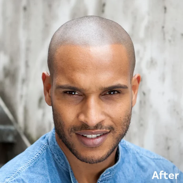 Best Scalp Micropigmentation Lloyd after
