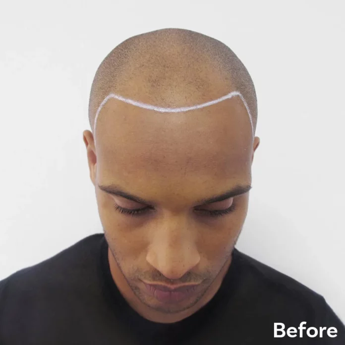 Best Scalp Micropigmentation Lloyd before