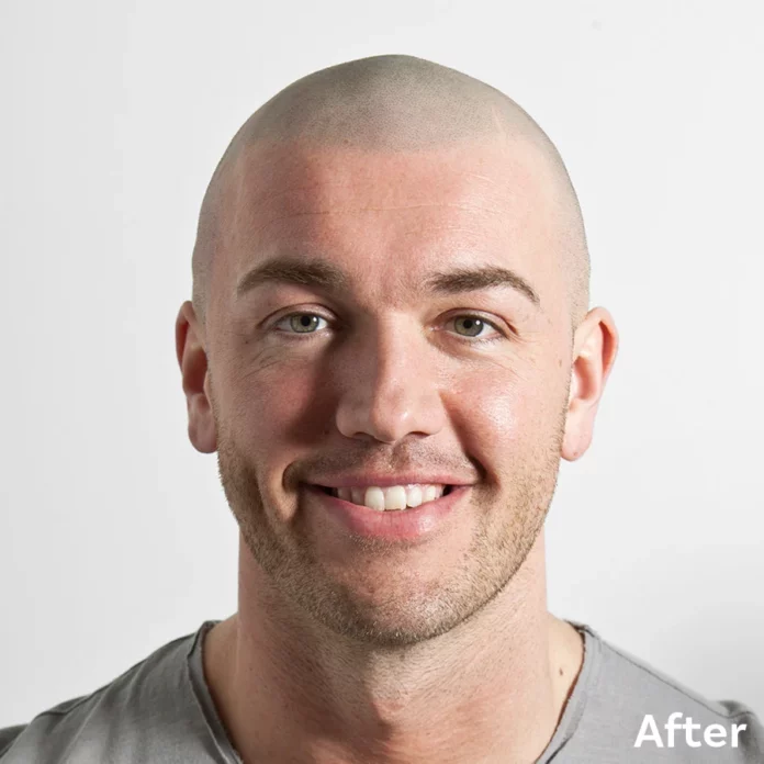 Best Scalp Micropigmentation Michael before