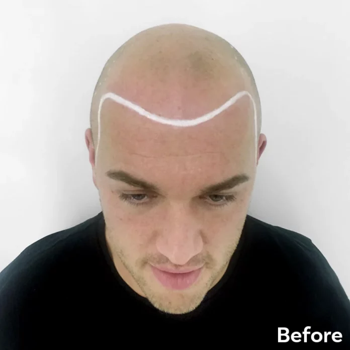 Best Scalp Micropigmentation Michael before