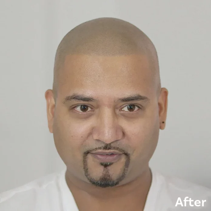 Best Scalp Micropigmentation Prem After