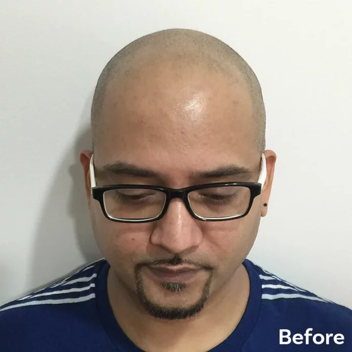 Best Scalp Micropigmentation Prem before