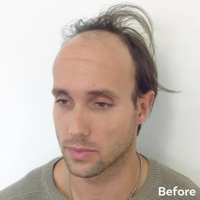 Best Scalp Micropigmentation Tony before