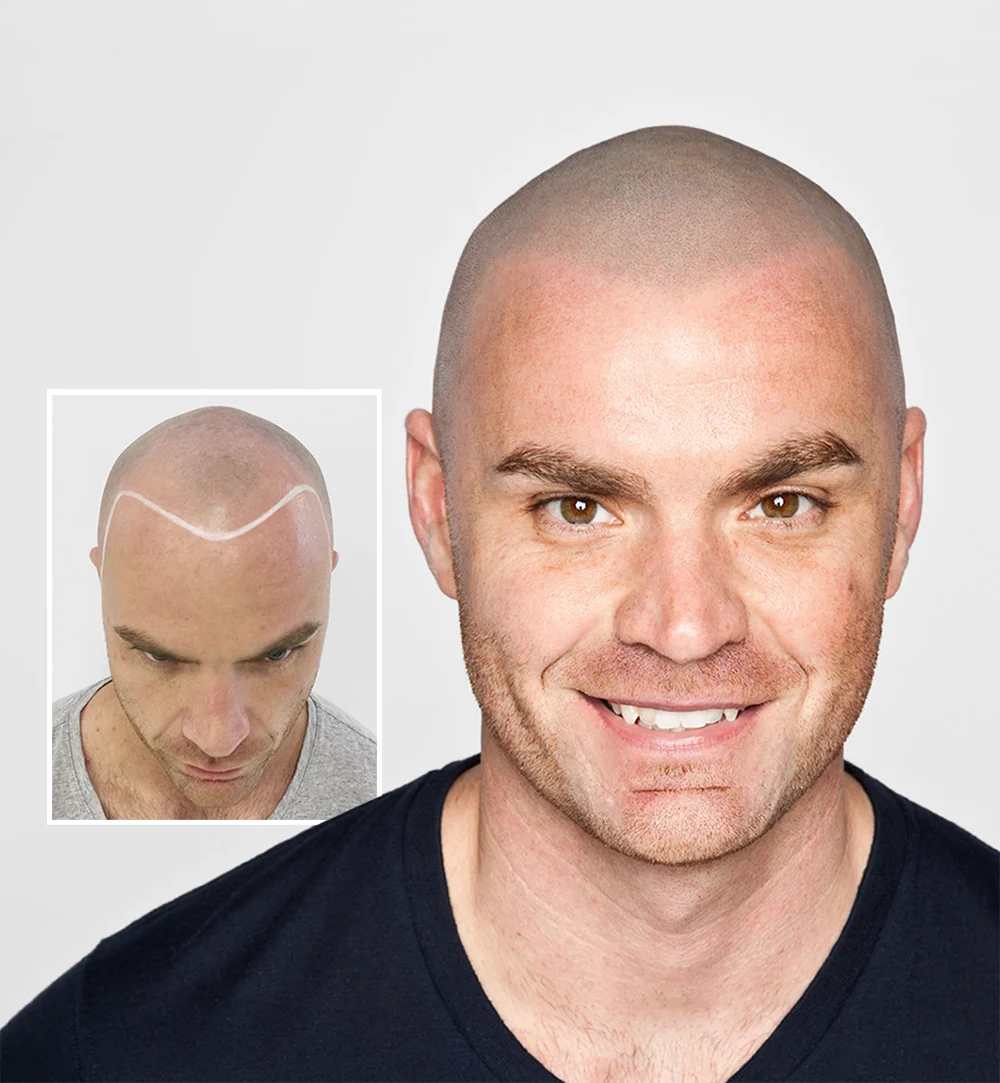 Best Scalp Micropigmentation clinics