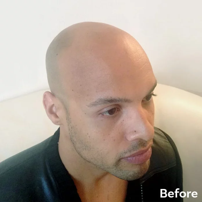 Best Scalp Micropigmentation Tristan before